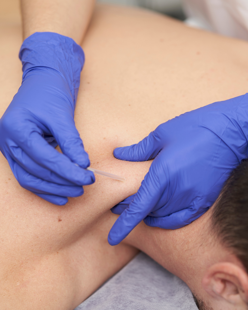 dry needling